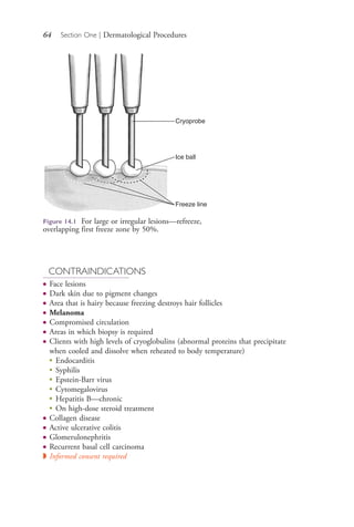 64 Section One | Dermatological Procedures
CONTRAINDICATIONS
● Face lesions
● Dark skin due to pigment changes
● Area that is hairy because freezing destroys hair follicles
● Melanoma
● Compromised circulation
● Areas in which biopsy is required
● Clients with high levels of cryoglobulins (abnormal proteins that precipitate
when cooled and dissolve when reheated to body temperature)
●
Endocarditis
●
Syphilis
●
Epstein-Barr virus
●
Cytomegalovirus
●
Hepatitis B—chronic
●
On high-dose steroid treatment
● Collagen disease
● Active ulcerative colitis
● Glomerulonephritis
● Recurrent basal cell carcinoma
◗ Informed consent required
Figure 14.1 For large or irregular lesions—refreeze,
overlapping first freeze zone by 50%.
Cryoprobe
Ice ball
Freeze line
4206_Chapter 1_0001-0120.indd 644206_Chapter 1_0001-0120.indd 64 12/24/2014 2:01:17 PM12/24/2014 2:01:17 PM
Process CyanProcess CyanProcess MagentaProcess MagentaProcess YellowProcess YellowProcess BlackProcess Black
 