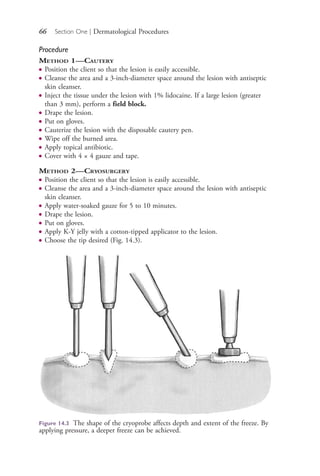 66 Section One | Dermatological Procedures
Procedure
METHOD 1—CAUTERY
● Position the client so that the lesion is easily accessible.
● Cleanse the area and a 3-inch-diameter space around the lesion with antiseptic
skin cleanser.
● Inject the tissue under the lesion with 1% lidocaine. If a large lesion (greater
than 3 mm), perform a field block.
● Drape the lesion.
● Put on gloves.
● Cauterize the lesion with the disposable cautery pen.
● Wipe off the burned area.
● Apply topical antibiotic.
● Cover with 4 × 4 gauze and tape.
METHOD 2—CRYOSURGERY
● Position the client so that the lesion is easily accessible.
● Cleanse the area and a 3-inch-diameter space around the lesion with antiseptic
skin cleanser.
● Apply water-soaked gauze for 5 to 10 minutes.
● Drape the lesion.
● Put on gloves.
● Apply K-Y jelly with a cotton-tipped applicator to the lesion.
● Choose the tip desired (Fig. 14.3).
Figure 14.3 The shape of the cryoprobe affects depth and extent of the freeze. By
applying pressure, a deeper freeze can be achieved.
4206_Chapter 1_0001-0120.indd 664206_Chapter 1_0001-0120.indd 66 12/24/2014 2:01:17 PM12/24/2014 2:01:17 PM
Process CyanProcess CyanProcess MagentaProcess MagentaProcess YellowProcess YellowProcess BlackProcess Black
 