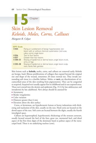 68 Section One | Dermatological Procedures
15Chapter
Skin Lesion Removal
Keloids, Moles, Corns, Calluses
Margaret R. Colyar
CPT Code
11050 Paring or curettement of benign hyperkeratotic skin
lesion with or without chemical cauterization (verrucae,
callus, corns), single lesion
11056 Two to four lesions
11057 Greater than four lesions
11300–33 Shaving of epidermal or dermal lesion, single lesion; trunk,
arms, or legs
11305–38 Shaving of epidermal or dermal lesion, single lesion; scalp,
neck, hands, feet, genitalia
Skin lesions such as keloids, moles, corns, and calluses are removed easily. Keloids
are benign, hard, fibrous proliferations of collagen that expand beyond the original
size and shape of the wound, sometimes 20 times normal size. They invade sur-
rounding soft tissue in a clawlike fashion. Moles, or nevi, are discolorations of cir-
cumscribed areas of the skin resulting from pigmentation. They can be congenital
or acquired. Acquired nevi usually appear first in childhood and in sun-exposed areas.
These nevi extend into the dermis and epidermis (Fig. 15.1) by late adolescence and
intradermis by late adulthood. Nevi always should be assessed for
● Asymmetry
● Border irregularities
● Color variation
● Diameter greater than 6 mm
● Elevation above the skin surface
Corns, or keratomas, are hyperkeratotic lesions or horny indurations with thick-
ening and nucleation of the skin, usually on the toes. Hard corns are located on the
dorsal aspect of the toes. Soft corns are located between the digits, usually the fourth
interdigital space.
Calluses are hypertrophied, hyperkeratotic thickenings of the stratum corneum,
usually located around the heel of the foot, great toe, metatarsal heel, and distal
aspect of the first three digits of the dominant hand or palmar aspect of the meta-
carpal head. There is no underlying nucleus (core).
4206_Chapter 1_0001-0120.indd 684206_Chapter 1_0001-0120.indd 68 12/24/2014 2:01:18 PM12/24/2014 2:01:18 PM
Process CyanProcess CyanProcess MagentaProcess MagentaProcess YellowProcess YellowProcess BlackProcess Black
 