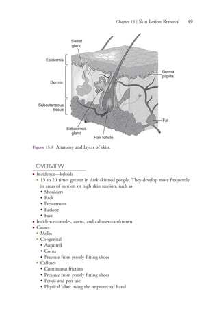 Chapter 15 | Skin Lesion Removal 69
OVERVIEW
● Incidence—keloids
●
15 to 20 times greater in dark-skinned people. They develop more frequently
in areas of motion or high skin tension, such as
• Shoulders
• Back
• Presternum
• Earlobe
• Face
● Incidence—moles, corns, and calluses—unknown
● Causes
●
Moles
●
Congenital
• Acquired
• Corns
• Pressure from poorly fitting shoes
●
Calluses
• Continuous friction
• Pressure from poorly fitting shoes
• Pencil and pen use
• Physical labor using the unprotected hand
Figure 15.1 Anatomy and layers of skin.
Sweat
gland
Epidermis
Dermis
Subcutaneous
tissue
Sebaceous
gland
Hair follicle
Fat
Derma
papilla
4206_Chapter 1_0001-0120.indd 694206_Chapter 1_0001-0120.indd 69 12/24/2014 2:01:18 PM12/24/2014 2:01:18 PM
Process CyanProcess CyanProcess MagentaProcess MagentaProcess YellowProcess YellowProcess BlackProcess Black
 