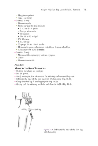Chapter 16 | Skin Tag (Acrochordon) Removal 75
●
Goggles—optional
● Tape—optional
● Method 1 only
●
Gloves—sterile
●
Sterile surgical kit that includes
• 2 × 2 or 4 × 4 gauze
• Forceps with teeth
• Iris scissors
• No. 11 or 15 scalpel
●
1% lidocaine
●
5-mL syringe
●
27-gauge, ½- to 1-inch needle
●
Hemostatic agent—aluminum chloride or ferrous subsulfate
●
Container with 10% formalin
● Method 2 only
●
Nitrous oxide cryosurgery unit or cryogun
●
Timer
●
Gloves—nonsterile
Procedure
METHOD 1—SNIPS TECHNIQUE
● Position the client for comfort.
● Put on gloves.
● Apply antiseptic skin cleanser to the skin tag and surrounding area.
● Infiltrate the base of the skin tag with 1% lidocaine (Fig. 16.1).
● Grasp the skin tag at the largest part (Fig. 16.2).
● Gently pull the skin tag until the stalk base is visible (Fig. 16.3).
Figure 16.1 Infiltrate the base of the skin tag
with lidocaine.
Skin tag
4206_Chapter 1_0001-0120.indd 754206_Chapter 1_0001-0120.indd 75 12/24/2014 2:01:18 PM12/24/2014 2:01:18 PM
Process CyanProcess CyanProcess MagentaProcess MagentaProcess YellowProcess YellowProcess BlackProcess Black
 