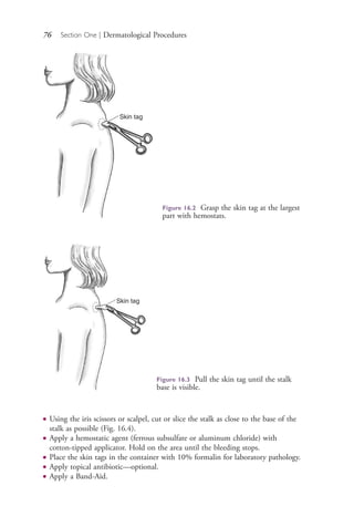 76 Section One | Dermatological Procedures
Skin tag
Figure 16.2 Grasp the skin tag at the largest
part with hemostats.
Skin tag
Figure 16.3 Pull the skin tag until the stalk
base is visible.
● Using the iris scissors or scalpel, cut or slice the stalk as close to the base of the
stalk as possible (Fig. 16.4).
● Apply a hemostatic agent (ferrous subsulfate or aluminum chloride) with
cotton-tipped applicator. Hold on the area until the bleeding stops.
● Place the skin tags in the container with 10% formalin for laboratory pathology.
● Apply topical antibiotic—optional.
● Apply a Band-Aid.
4206_Chapter 1_0001-0120.indd 764206_Chapter 1_0001-0120.indd 76 12/24/2014 2:01:18 PM12/24/2014 2:01:18 PM
Process CyanProcess CyanProcess MagentaProcess MagentaProcess YellowProcess YellowProcess BlackProcess Black
 