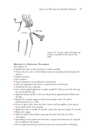 Chapter 16 | Skin Tag (Acrochordon) Removal 77
METHOD 2—CRYOGENIC TECHNIQUE
See Chapter 14.
● Position the client so that the lesion is easily accessible.
● Cleanse the area and a 3-inch-diameter space surrounding with antiseptic skin
cleanser.
● Drape the lesion.
● Put on gloves.
● Prepare equipment as manufacturer recommends.
● Select the appropriate-size device to match the size of the lesion.
● Anesthetize the site—optional.
● Use a cotton-tipped applicator to apply enough K-Y jelly to cover the skin tag
but not beyond the tag.
● Apply the selected probe to the site and penetrate approximately halfway into
the jelly.
● Squeeze the cryogun trigger to release the nitrogen oxide. The jelly is
transformed into an ice ball.
● If area of skin is thin, when the jelly is frozen, pull up slightly on the skin to
lessen depth of the tissue freezing.
● Application time is usually 30 seconds. Larger skin tags may require 45 seconds.
● Release the trigger.
● Allow the jelly to thaw before removing the probe from the site of the
cryosurgery.
● Depending on the response of the lesion, a repeat freeze-thaw may be required
for an additional 30 seconds.
● Do not apply any dressing until lesion becomes irritated and/or is bleeding.
Skin tag
Figure 16.4 Cut the stalk of the skin tag
as close as possible to the base of the
stalk.
4206_Chapter 1_0001-0120.indd 774206_Chapter 1_0001-0120.indd 77 12/24/2014 2:01:18 PM12/24/2014 2:01:18 PM
Process CyanProcess CyanProcess MagentaProcess MagentaProcess YellowProcess YellowProcess BlackProcess Black
 