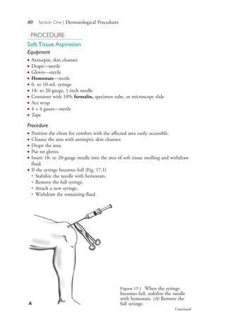 80 Section One | Dermatological Procedures
PROCEDURE
Soft Tissue Aspiration
Equipment
● Antiseptic skin cleanser
● Drape—sterile
● Gloves—sterile
● Hemostats—sterile
● 6- to 10-mL syringe
● 18- to 20-gauge, 1-inch needle
● Container with 10% formalin, specimen tube, or microscope slide
● Ace wrap
● 4 × 4 gauze—sterile
● Tape
Procedure
● Position the client for comfort with the affected area easily accessible.
● Cleanse the area with antiseptic skin cleanser.
● Drape the area.
● Put on gloves.
● Insert 18- to 20-gauge needle into the area of soft tissue swelling and withdraw
fluid.
● If the syringe becomes full (Fig. 17.1)
● Stabilize the needle with hemostats.
● Remove the full syringe.
● Attach a new syringe.
● Withdraw the remaining fluid.
Figure 17.1 When the syringe
becomes full, stabilize the needle
with hemostats. (A) Remove the
full syringe.A
Continued
4206_Chapter 1_0001-0120.indd 804206_Chapter 1_0001-0120.indd 80 12/24/2014 2:01:18 PM12/24/2014 2:01:18 PM
Process CyanProcess CyanProcess MagentaProcess MagentaProcess YellowProcess YellowProcess BlackProcess Black
 