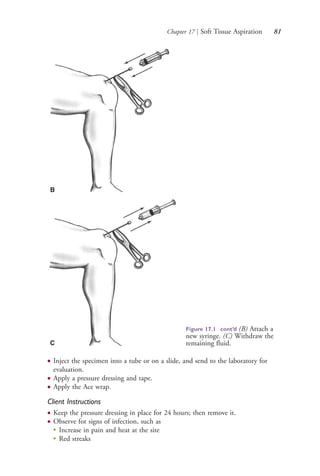 Chapter 17 | Soft Tissue Aspiration 81
● Inject the specimen into a tube or on a slide, and send to the laboratory for
evaluation.
● Apply a pressure dressing and tape.
● Apply the Ace wrap.
Client Instructions
● Keep the pressure dressing in place for 24 hours; then remove it.
● Observe for signs of infection, such as
●
Increase in pain and heat at the site
●
Red streaks
B
C
Figure 17.1 cont’d (B) Attach a
new syringe. (C) Withdraw the
remaining fluid.
4206_Chapter 1_0001-0120.indd 814206_Chapter 1_0001-0120.indd 81 12/24/2014 2:01:18 PM12/24/2014 2:01:18 PM
Process CyanProcess CyanProcess MagentaProcess MagentaProcess YellowProcess YellowProcess BlackProcess Black
 