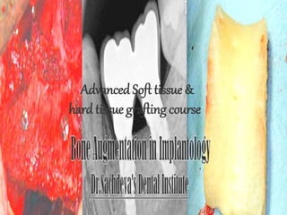 Advanced Soft tissue &
hard tissue grafting course
 