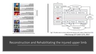 Reconstruction and Rehabilitating the injured upper limb
J Neurosurg 127:1163–1171, 2017
 