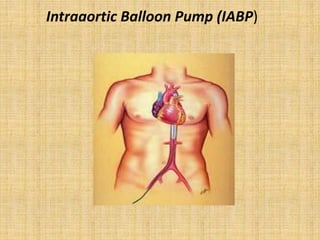 Intraaortic Balloon Pump (IABP)
 