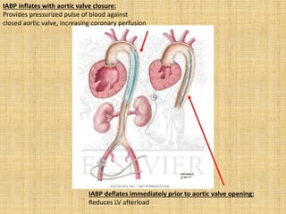 IABP inflates with aortic valve closure:
Provides pressurized pulse of blood against
closed aortic valve, increasing coronary perfusion
IABP deflates immediately prior to aortic valve opening:
Reduces LV afterload
 