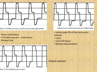 • Initial under fill of the intra-aortic
balloon
• Leak
• Auto-fill failure
• Balloon disconnected
Auto-vent failure
 Possible vacuum malfunction
Kinked Line
Kinked catheter.
 