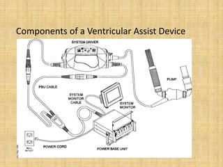Components of a Ventricular Assist Device
 