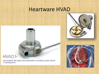 Heartware HVAD
 