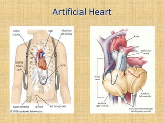 Artificial Heart
 