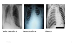 Tension Pneumothorax Massive Hemothorax Flial chest
10/14/2023 24
 