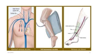 Central venous access Intraosseous access Venous cut down
10/14/2023 31
 