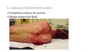 E - Exposure / Environment control
Completely undress the patient,
Always Inspect the Back
35
10/14/2023
 