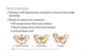 Pelvic ring injuries
Patients with hypotension and pelvic fractures have high
mortality.
Based on injury force patterns:
 AP compression-External rotation
 lateral compression-Internal rotation
 vertical shear, and
 combined mechanism
52
10/14/2023
 