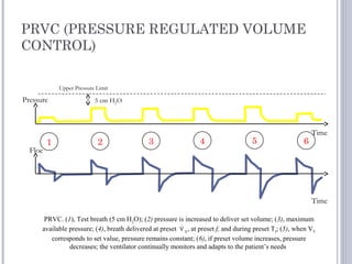 PRVC (PRESSURE REGULATED VOLUME
CONTROL)
PRVC. (1), Test breath (5 cm H2
O); (2) pressure is increased to deliver set volume; (3), maximum
available pressure; (4), breath delivered at preset E
, at preset f, and during preset TI
; (5), when VT
corresponds to set value, pressure remains constant; (6), if preset volume increases, pressure
decreases; the ventilator continually monitors and adapts to the patient’s needs
1 2 3 4 5 6
Upper Pressure Limit
5 cm H2OPressure
Floe
Time
Time
 