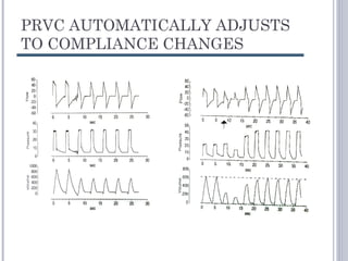PRVC AUTOMATICALLY ADJUSTS
TO COMPLIANCE CHANGES
 