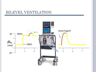 BILEVEL VENTILATION
PEEPPEEPHH
PEEPPEEPLL
Pressure SupportPressure Support
PEEPPEEPHighHigh + PS+ PS
PPawaw
cmHcmH2200
6060
-20-20
1 2 3 4 5 6 7
 
