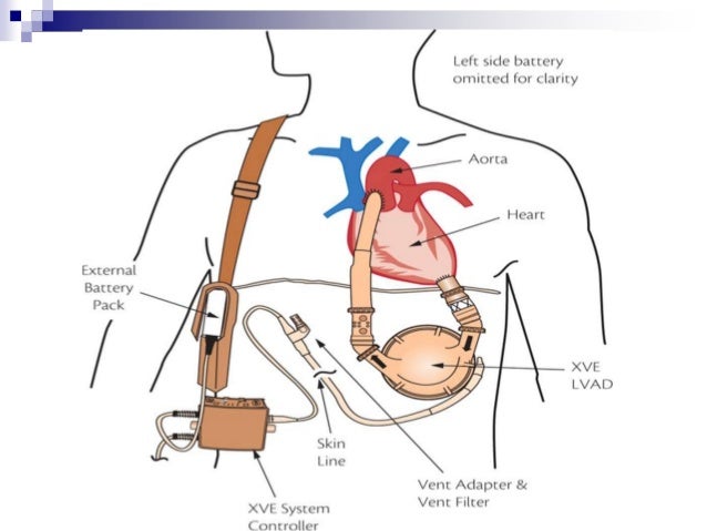 Advanced ventricular assist device ppt