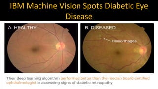 IBM Machine Vision Spots Diabetic Eye
Disease
 
