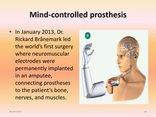 Mind-controlled prosthesis
• In January 2013, Dr.
Rickard Brånemark led
the world’s first surgery
where neuromuscular
electrodes were
permanently implanted
in an amputee,
connecting prostheses
to the patient’s bone,
nerves, and muscles.
06-04-2022 34
 