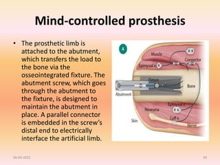 Mind-controlled prosthesis
• The prosthetic limb is
attached to the abutment,
which transfers the load to
the bone via the
osseointegrated fixture. The
abutment screw, which goes
through the abutment to
the fixture, is designed to
maintain the abutment in
place. A parallel connector
is embedded in the screw’s
distal end to electrically
interface the artificial limb.
06-04-2022 39
 