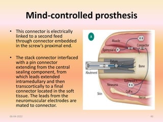 Mind-controlled prosthesis
• This connector is electrically
linked to a second feed
through connector embedded
in the screw’s proximal end.
• The stack connector interfaced
with a pin connector
extending from the central
sealing component, from
which leads extended
intramedullary and then
transcortically to a final
connector located in the soft
tissue. The leads from the
neuromuscular electrodes are
mated to connector.
06-04-2022 40
 