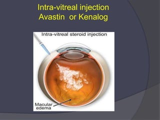 Vitrinal Injection Advances in Amd And Oct | PPTX