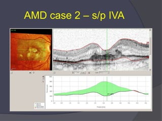 Advances in Amd And Oct | PPTX