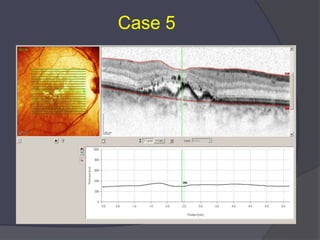 Advances in Amd And Oct | PPTX