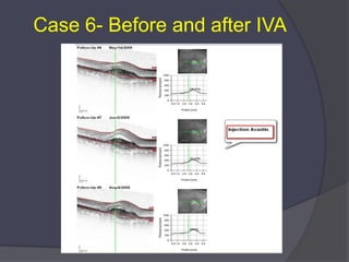 Advances in Amd And Oct | PPTX