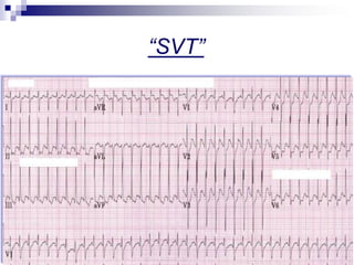 ECG in Emergency Department - Advances in ACS ECG | PDF
