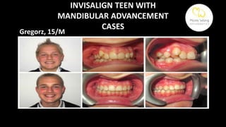 ADVANCES IN ALIGNER TREATMENT | PPTX