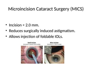 Advances_in_Cataract_Surgery_Undergraduate_Lecture.pptx