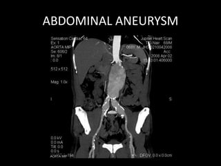 ABDOMINAL ANEURYSM
 