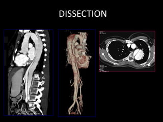 DISSECTION
 