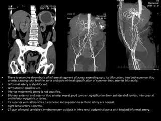 • There is extensive thrombosis of infrarenal segment of aorta, extending upto its bifurcation; into both common iliac
arteries causing total block in aorta and only minimal opacification of common ileac arteries bilaterally.
• Left renal artery is also blocked.
• Left kidney is small in size.
• Inferior mesenteric artery is not opacified.
• Bilateral external and internal iliac arteries reveal good contrast opacification from collateral of lumbar, intercoastal
and inferior epigastric arteries.
• Its superior ventral branches (i.e) coeliac and superior mesenteric artery are normal.
• Right renal artery is normal.
• CT scan of reveal Lehriche’s syndrome seen as block in infra renal abdominal aorta with blocked left renal artery.
 