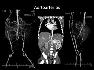 Aortoarteritis
 