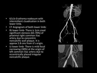 • K/c/o Erythema nodosum with
intermittent cluadication in both
lower limb.
• CT Angiogram of both lower limb:
• Rt lower limb- There is 1cm sized
significant stenosis (65-70%) of
proximal right common iliac
artery due to concentric
noncalcific wall plaque. It is
approx 2.8 cms from it’s origin.
• Lt lower limb- There is mild focal
narrowing (30%) at the origin of
left common iliac artery due to
eccentrically placed irregular
noncalcific plaque.
 