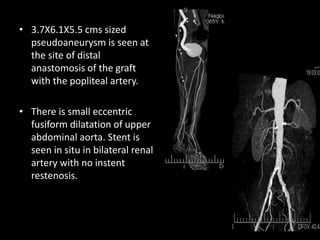 • 3.7X6.1X5.5 cms sized
pseudoaneurysm is seen at
the site of distal
anastomosis of the graft
with the popliteal artery.
• There is small eccentric
fusiform dilatation of upper
abdominal aorta. Stent is
seen in situ in bilateral renal
artery with no instent
restenosis.
 