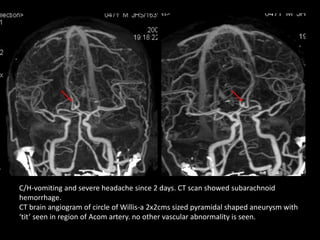 C/H-vomiting and severe headache since 2 days. CT scan showed subarachnoid
hemorrhage.
CT brain angiogram of circle of Willis-a 2x2cms sized pyramidal shaped aneurysm with
‘tit’ seen in region of Acom artery. no other vascular abnormality is seen.
 