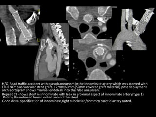 H/O-Road traffic accident with pseudoaneurysm in the innominate artery which was stented with
FLUENCY plus vascular stent graft. 12mmx60mm{56mm covered graft material}.post deployment
arch aortogram shows minimal endoleak into the false aneurysm.
Repeat CT-shows stent in innominate with leak in proximal aspect of innominate artery{type 1}
.Patchy thrombosed lumen noted around the stent.
Good distal opacification of innominate,right subclavian/common carotid artery noted.
 