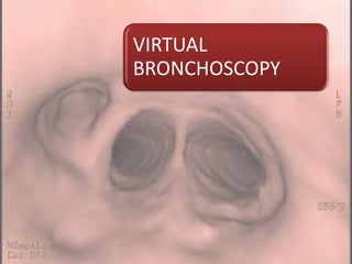 VIRTUAL
BRONCHOSCOPY
 