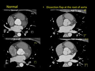 • Dissection flap at the root of aortaNormal
 