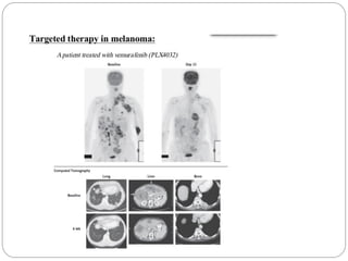 Advances in Diagnosis & Imaging Impacting Cancer Treatment | PDF