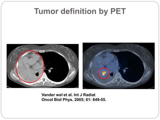 Advances in Diagnosis & Imaging Impacting Cancer Treatment | PDF