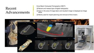 Recent
Advancements
Cone Beam Computed Tomography (CBCT)
 Recent and newest type of digital radiography
 Scan in the area of image taken and resultant image is displayed as image
slices
 Mainly used for impant planning and removal of third molars
 