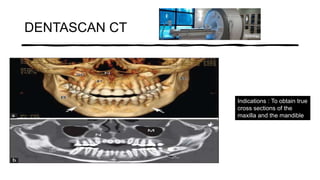 DENTASCAN CT
Indications : To obtain true
cross sections of the
maxilla and the mandible
 